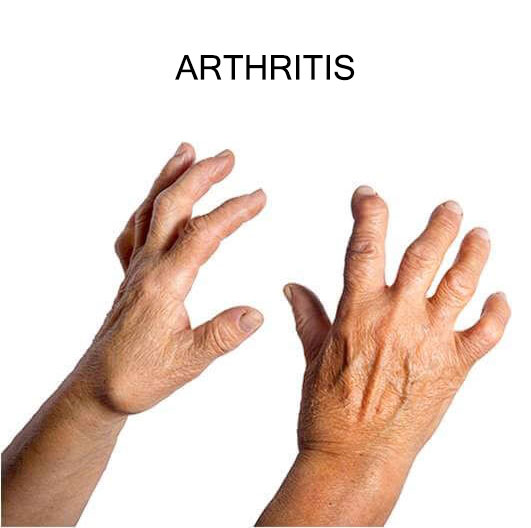 Arthritis Treatment | Fast recovery | Verddaan Hospital