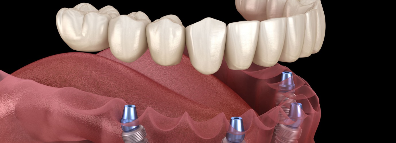 Why Dental Implants Melbourne Are the Best Solution for Missing Teeth