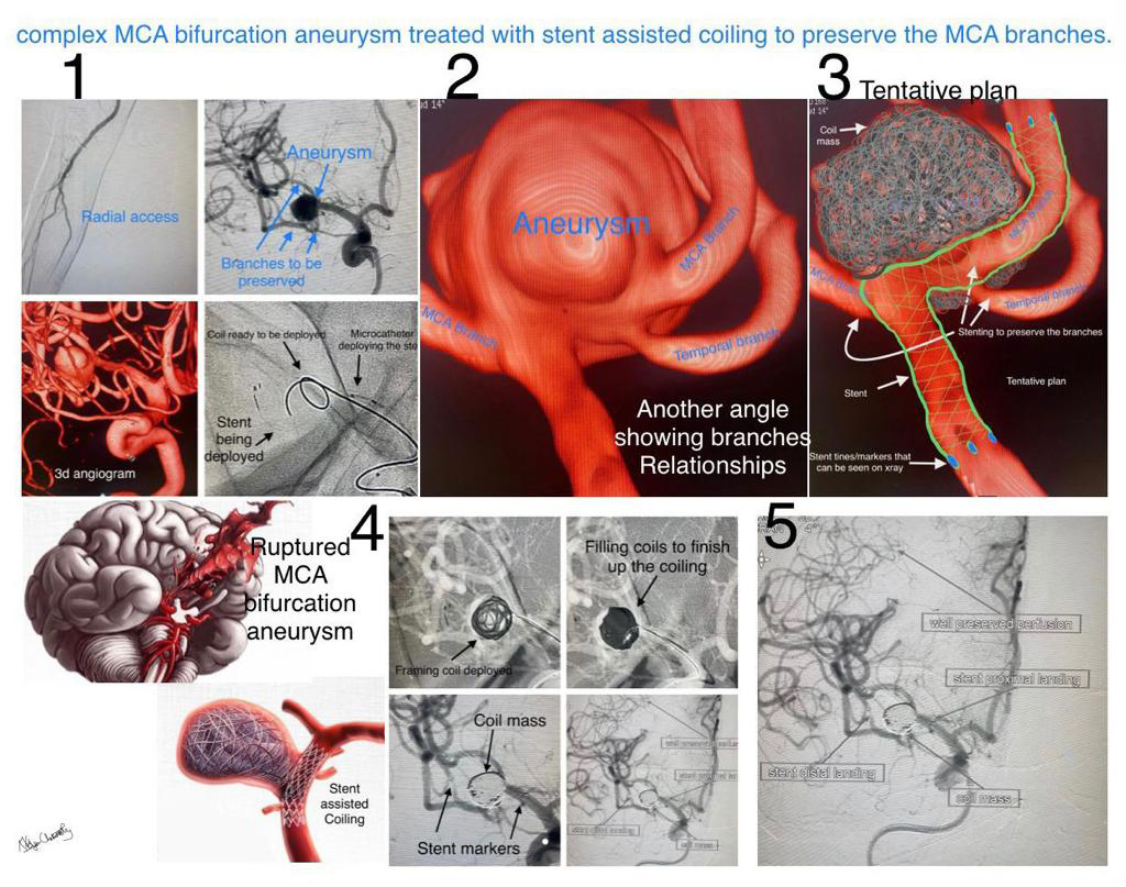 Coiling Aneurysm Procedure & Treatment Cost in Ahmedabad, Udaipur, Bhilwara, Jodhpur, Surat, Gujarat