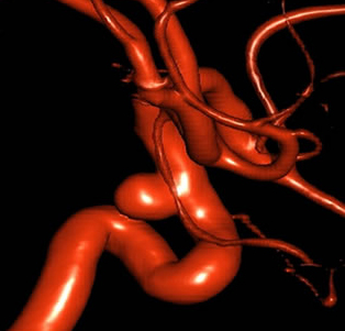Aneurysm Brain Symptoms & Treatment Center in Ahmedabad, Udaipur, Bhilwara, Jodhpur, Surat, Gujarat