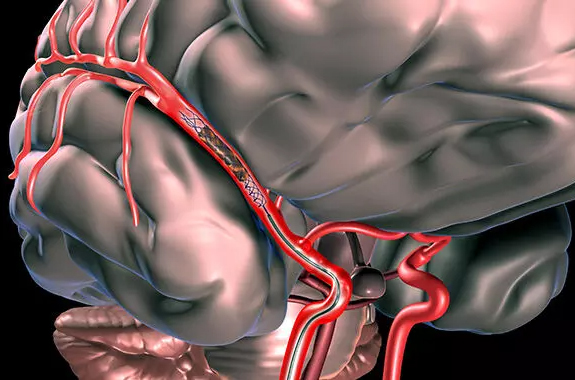 Stroke Symptoms & Treatment Center in Ahmedabad, Udaipur, Bhilwara, Jodhpur, Surat, Gujarat