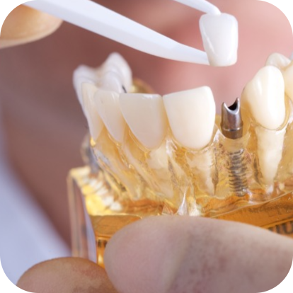 What Makes Cheapest Dental Implants Melbourne Worth Considering – zensmilesblog